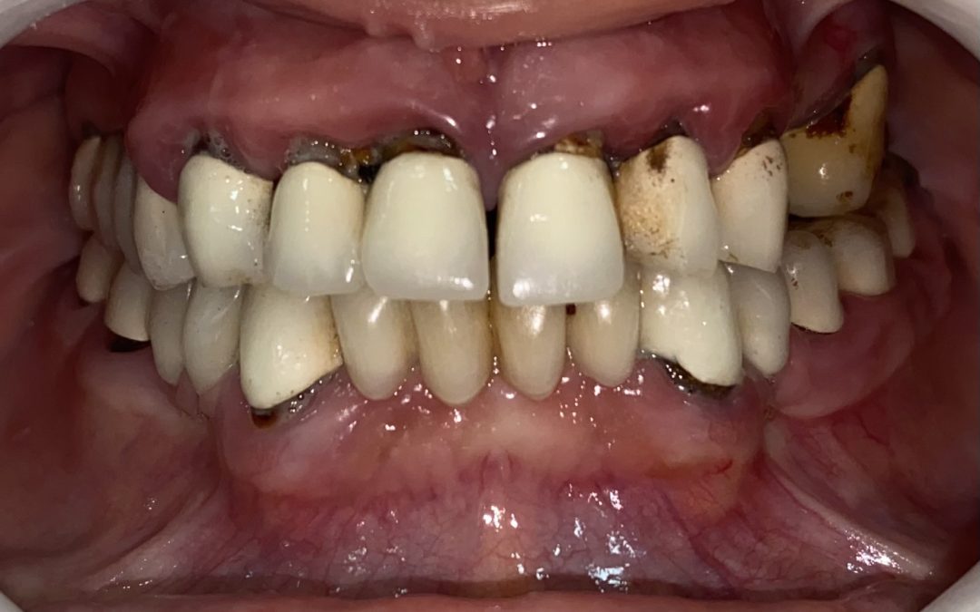 Diş Eti hastalığı
