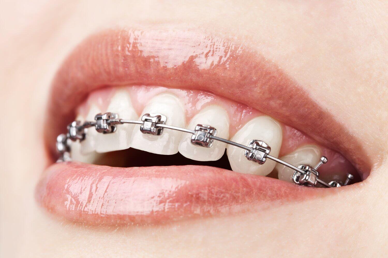ortodonti dis teli tedavisi