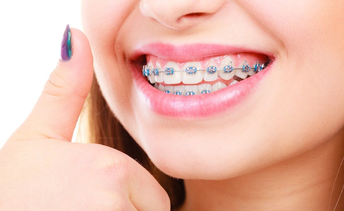 ortodonti tedavisnin avantajlari