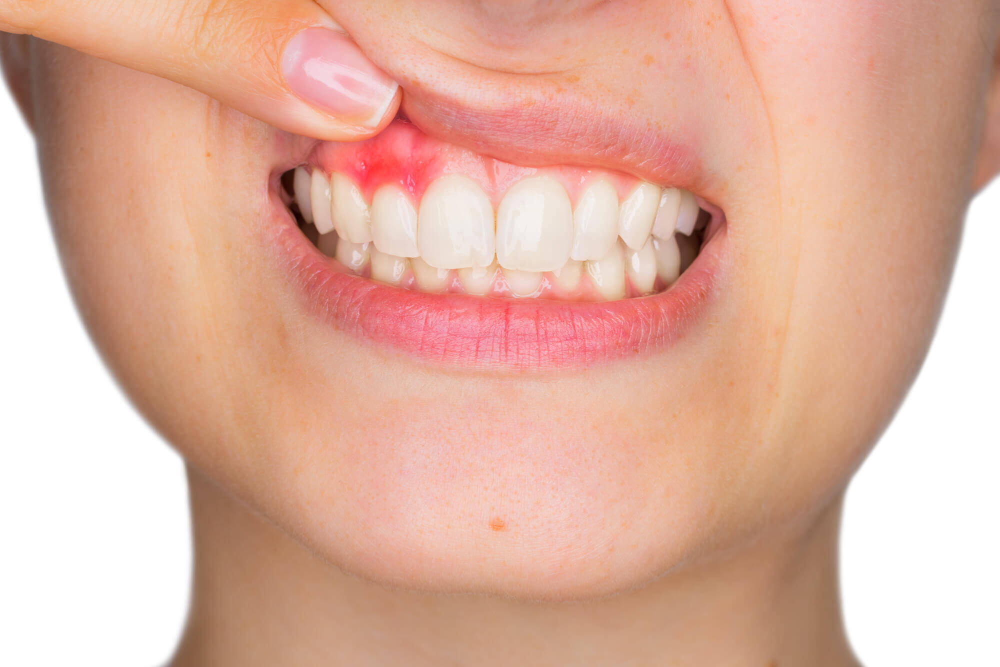 periodontal hastaliklar